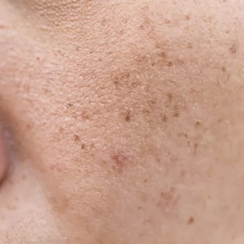 Tranexamic Acid for Skin: The Science, Benefits, and How It Transforms Your Complexion 6 Tranexamic Acid for Skin Reduces Dark Spots and Hyperpigmentation